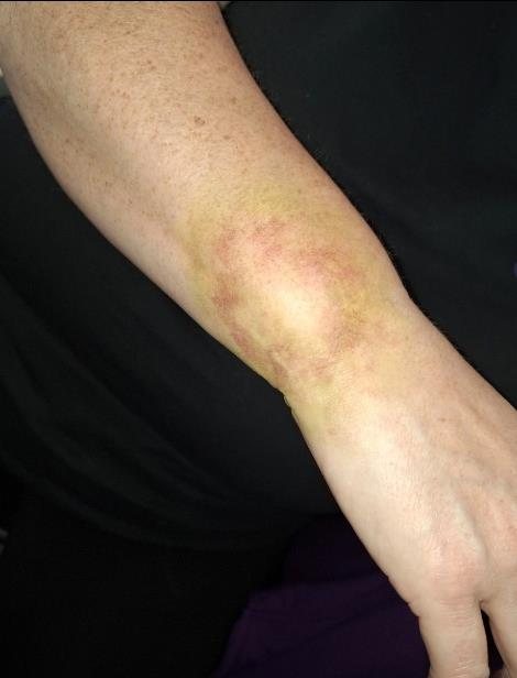 Bruising special effects on arm